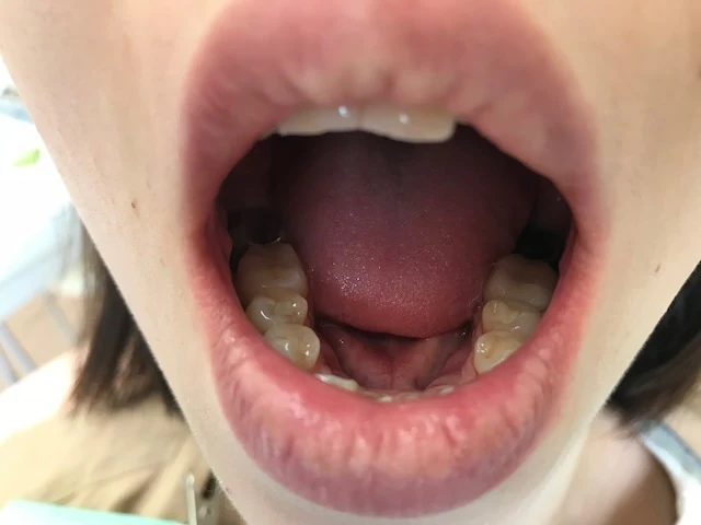 口を開いた状態で白い奥歯が見える口腔内